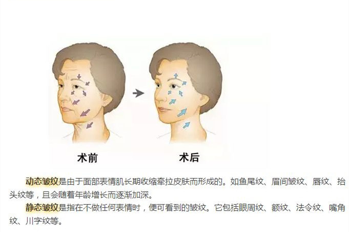 法令纹填充玻尿酸显老,玻尿酸填充法令纹显老怎么办