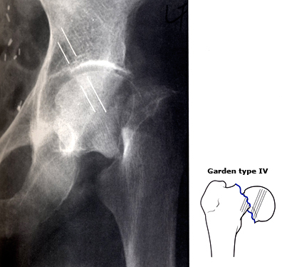 29岁右股骨颈骨折恢复最佳的方法,82老人股骨头摔骨折了该怎样治疗