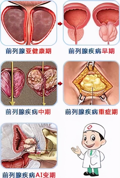 前列腺炎怎么会引起生殖功能障碍,前列腺炎正在“蚕食”男性健康