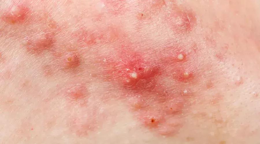 汉珍草湿疹膏含激素吗,宝宝湿疹可以涂湿疹霜吗