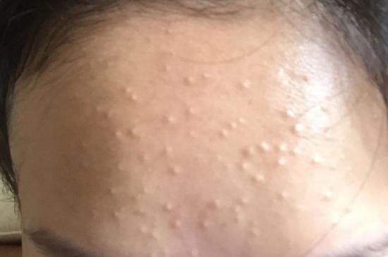 我的战痘历程简介,战痘路上的心酸史