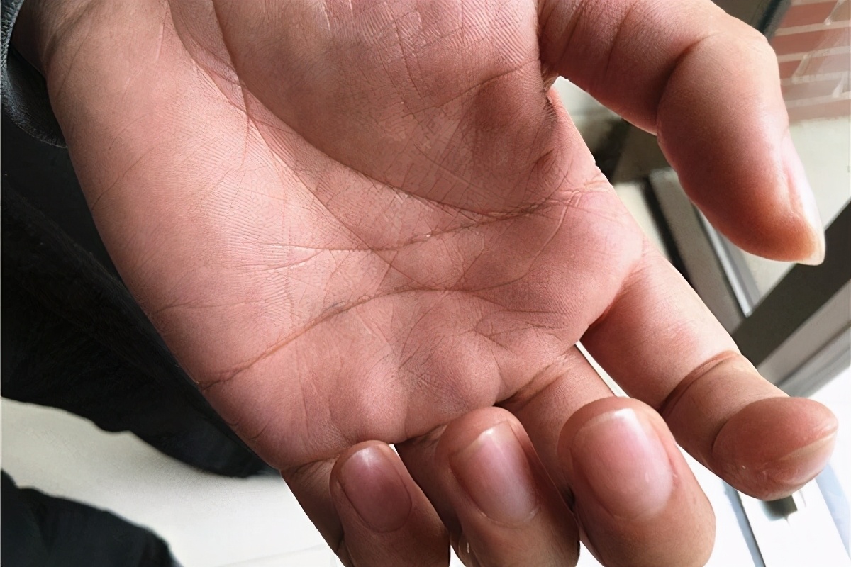 婴儿热水烫伤怎么处理皮肤科,烫伤后皮肤是怎么恢复的