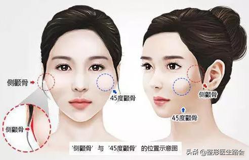 颧骨高容易变成菱形脸吗,颧骨高显得老