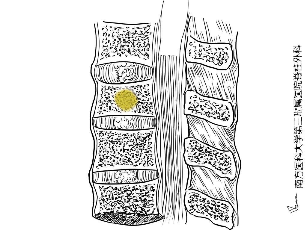 结核药物不良反应哪些,各类抗结核药的不良反应