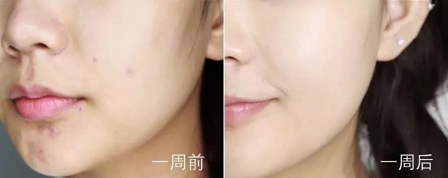 祛痘印最有效的方法排名,祛痘印淡化痘印用什么药膏