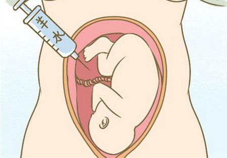 妇产科医生：什么是羊水穿刺？哪些孕妈妈需要做这个检查？
