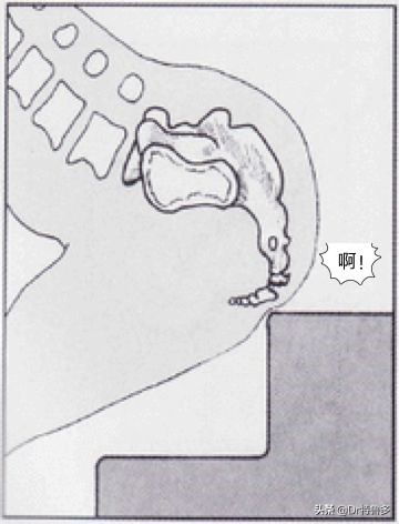 不明原因的尾骨痛怎么治疗最好,一坐下尾骨疼是怎么回事女性