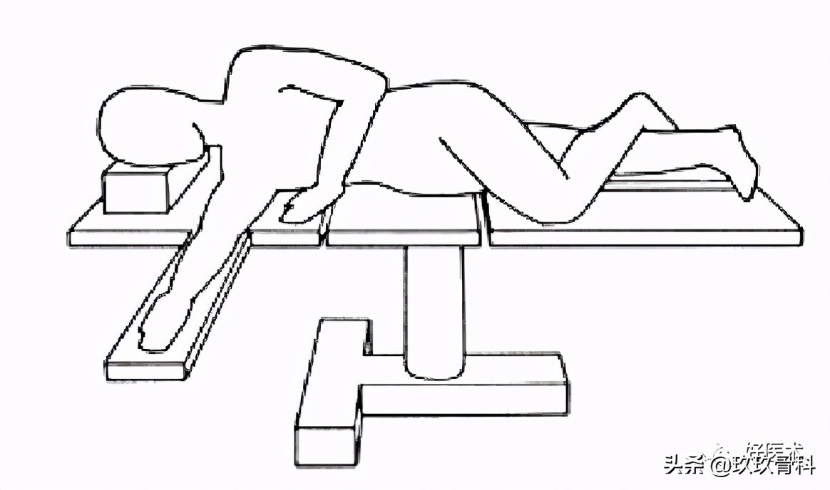 髓内钉技巧,髓内钉教学视频讲解