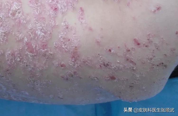 得了银屑病用什么药膏才能好,得了银屑病要预防什么