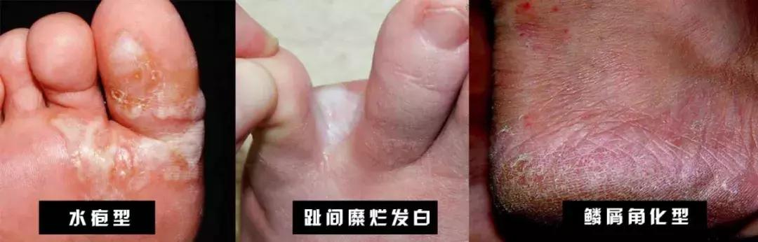 小小脚气危害大，春季正高发，孕妈中招能用药吗？