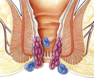 都说十人九痔痔疮能根治吗,十人九痔八不治