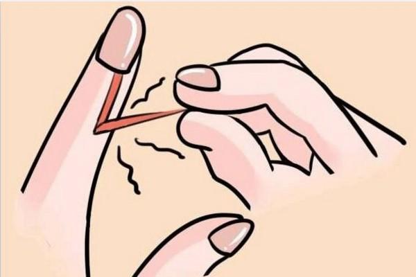 如何判断手上水泡是手癣还是疱疹,忍不住撕手指皮怎么办