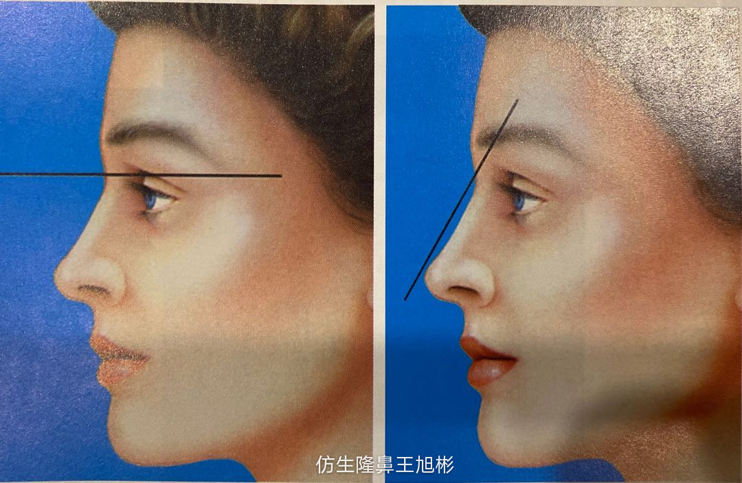 窄鼻子如何通过鼻整形来矫正,宽鼻子矫正方法