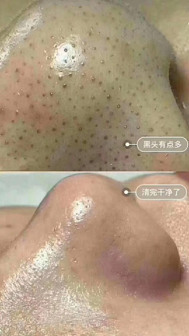 毛孔黑头堵塞严重变成一片疙瘩,敏感肌毛孔堵塞黑头怎么改善