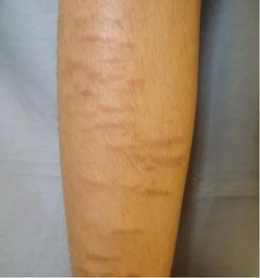 AD可能影响孩子的睡眠、教育、发展和自尊心,但激素药膏要慎用