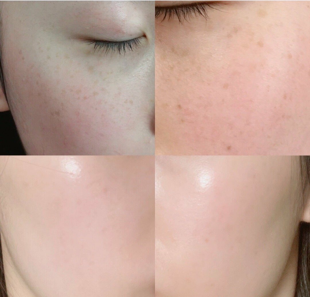 如何祛斑10种祛斑的简单最佳方法,祛斑方法教你如何祛斑最快最有效