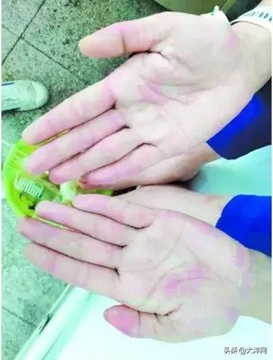 19岁女孩天天吃鱼，竟导致手脚“满目疮痍”！医生一句话说出真相