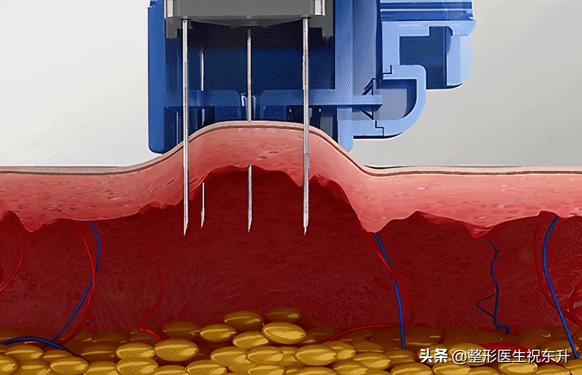 光子嫩肤果酸换肤水光针顺序,皮秒和光子嫩肤的区别效果对比