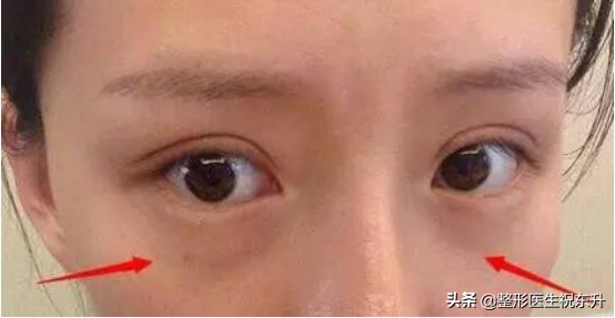 眼袋困扰多年不要急试试这个方法,消除眼袋也有省钱又省时的好方法