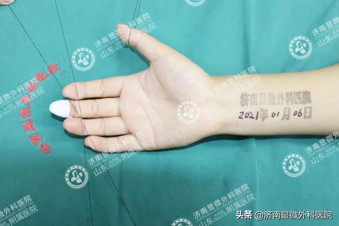 显微镜下男性复通术需要多少钱,显微镜下的手指再植