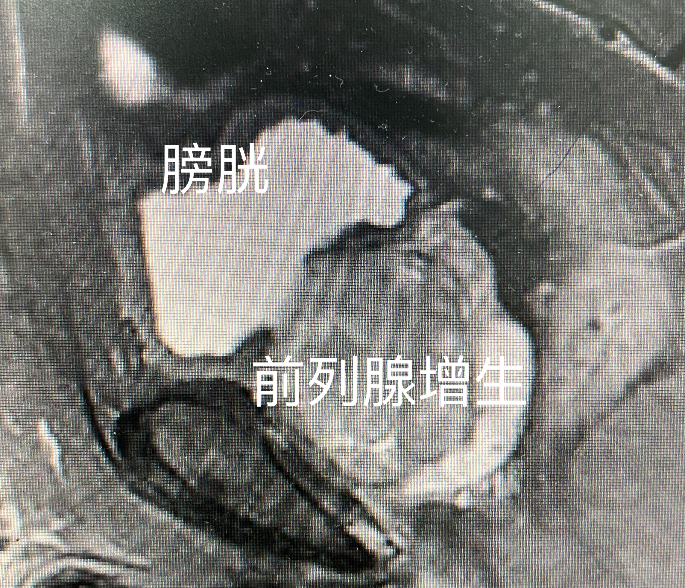 小便带血应该到什么科就医,男性小便带血如何治疗