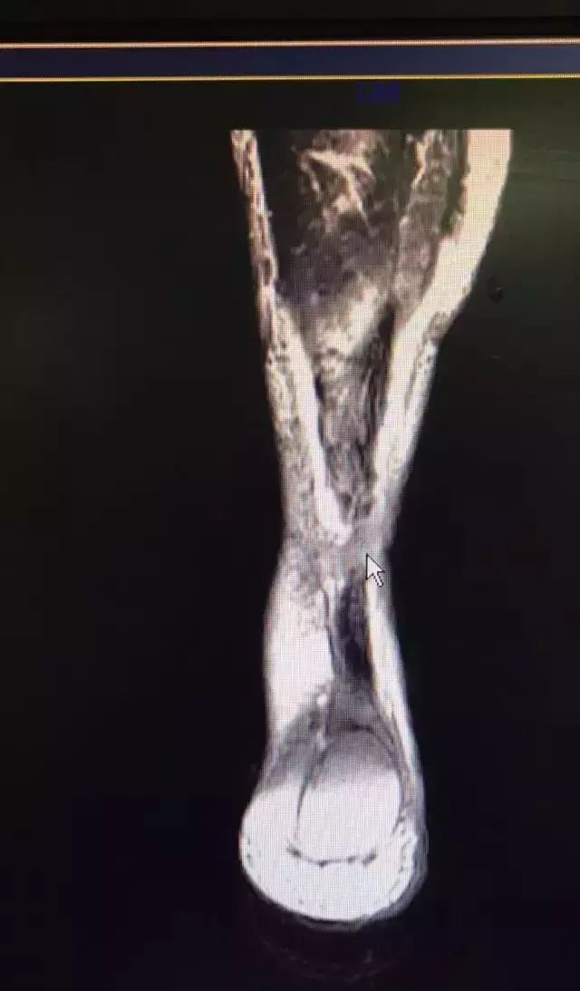 猛于虎伤病季后赛,勇士对猛龙汤普森受伤片段