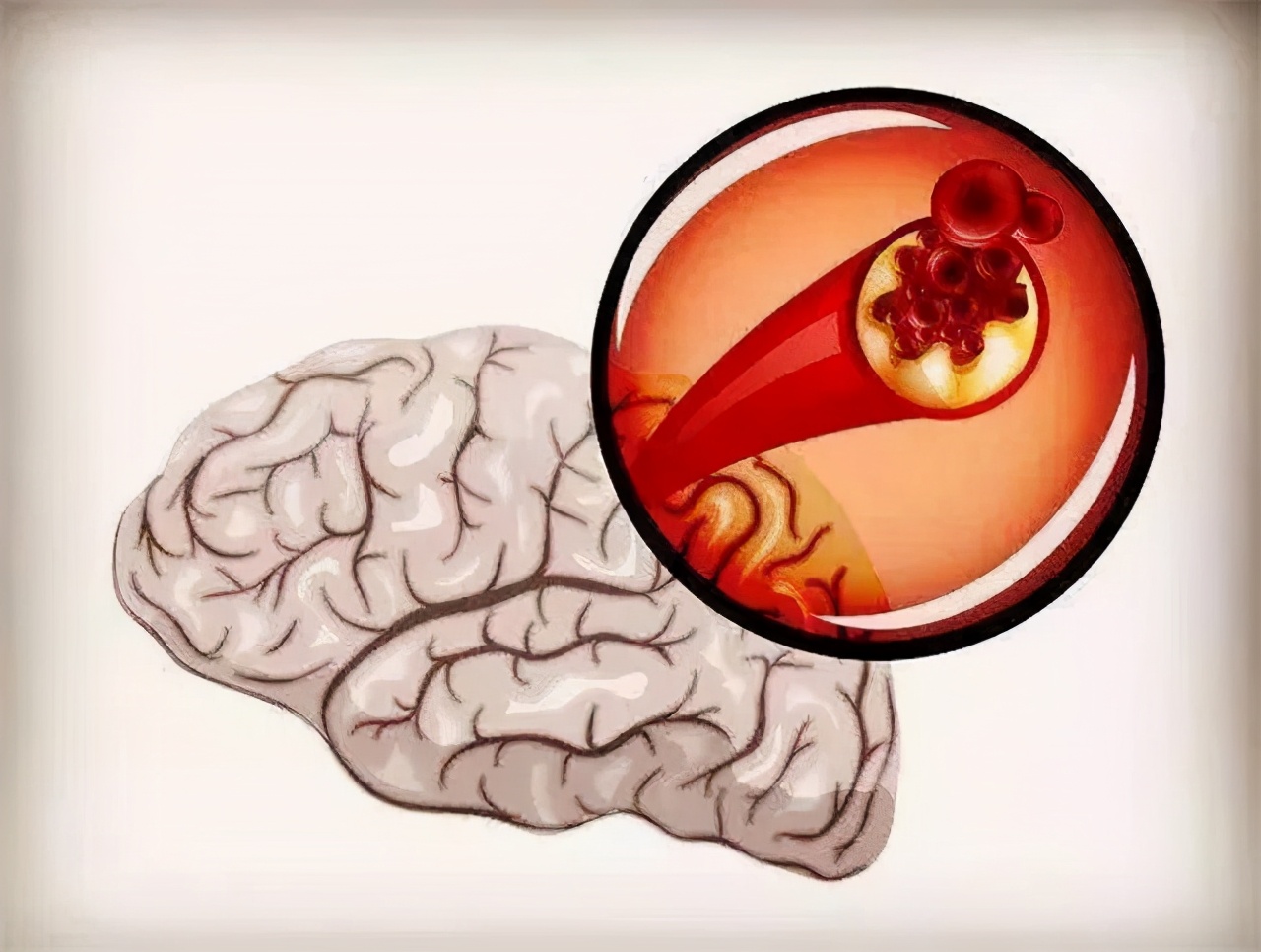 高血压腿麻会得脑梗吗,高血压会不会一直没感觉突然脑梗