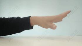 用手机大拇指腱鞘炎能自愈吗,长时间玩手机手腕腱鞘炎的案例