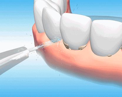 洗牙后茶渍不见了！可牙齿酸酸的是怎么回事？