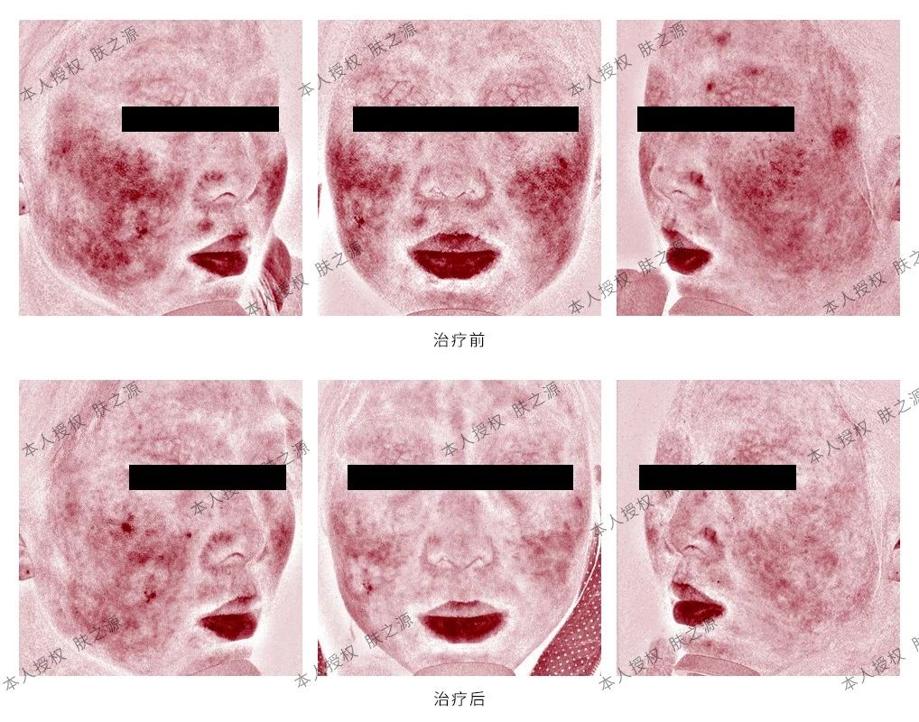 玫瑰痤疮患者自述,治疗玫瑰痤疮案例分享