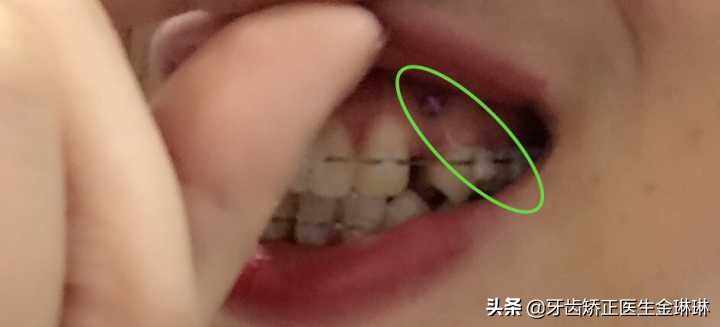 牙齿矫正拔牙牙缝多久能关上,淄博牙齿矫正一般多少钱