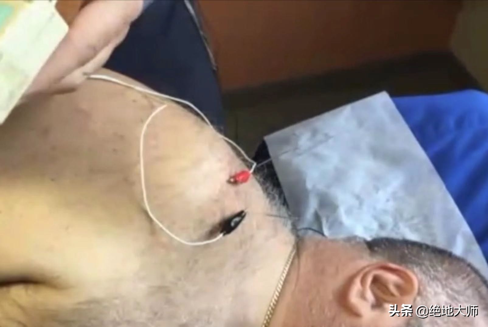 脊神经脉冲射频术后如何康复训练,神经射频术后疼痛难忍