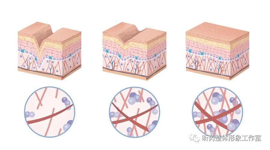 肥胖纹真的是因为肥胖而导致的吗,比胖更可怕的是松弛和下垂