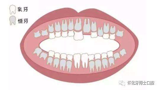 乳牙坏了不用管等换牙可以吗,乳牙坏了不做根管可以直接补吗