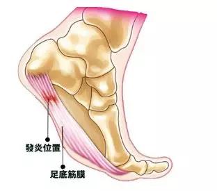 脚痛有什么快速不痛的方法,脚疼都是什么毛病
