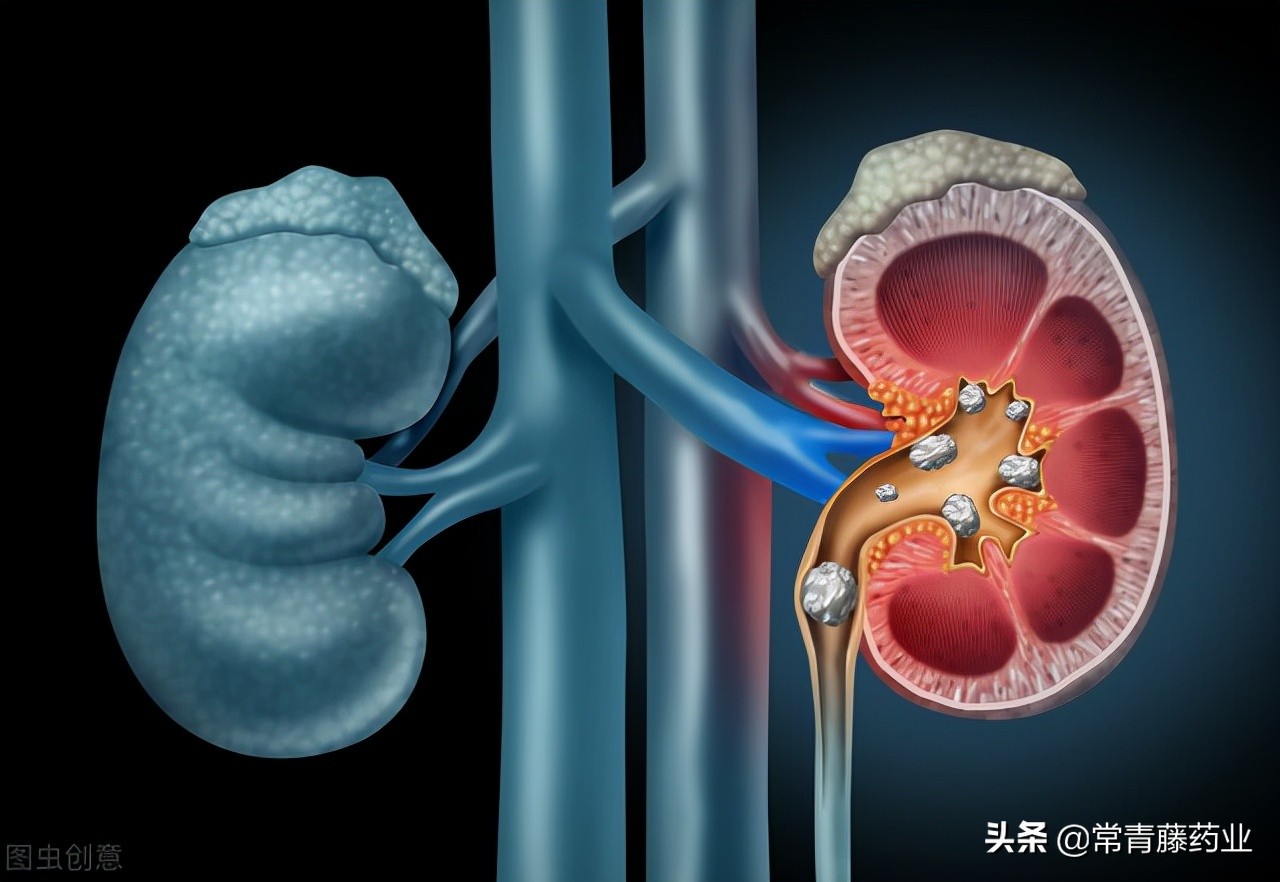 体检查出有肾结石要注意什么,肾结石怎么治疗彻底