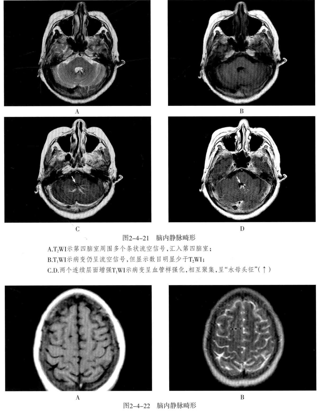颅内血管周围间隙的影像鉴别,颅脑血管源性疾病影像诊断
