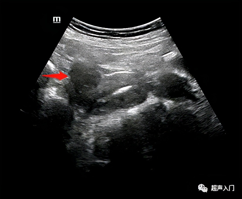 超声怎么分辨前后位子宫,超声如何区分子宫前后位