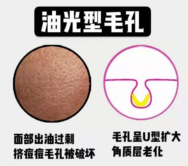 毛孔粗大黑头多怎么改善小技巧,毛孔粗大黑头多的原因和改善方法