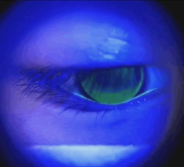 孩子眼睛近视加散光如何治疗,儿童视力散光180度怎么办