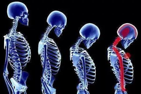 腰部脊椎疼是强直嘛,腰部强直是什么引起的