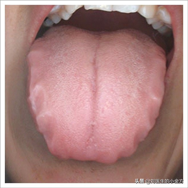 中医舌诊对照表100例,舌诊辨九大体质