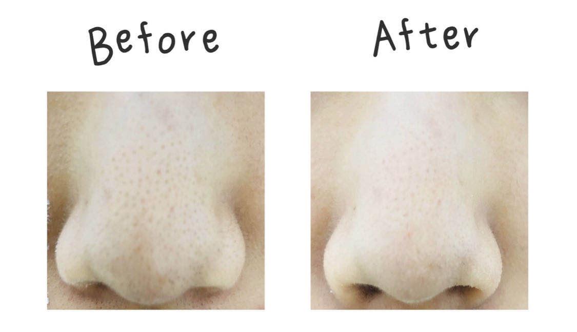 去黑头完了如何修复,去黑头省钱攻略