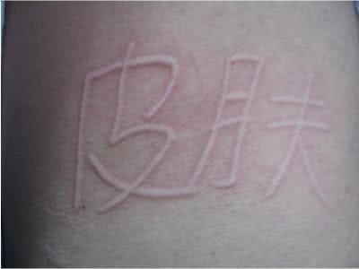 荨麻疹是由麻疹病毒引起的吗,麻疹是伤寒吗