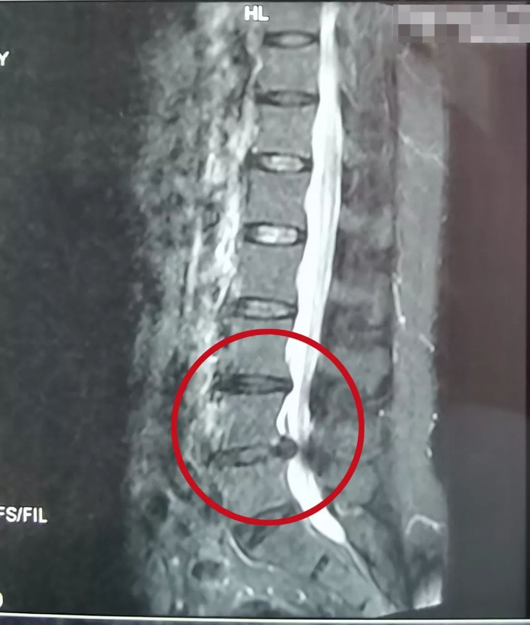腰椎间盘突出椎管狭窄完整病历,腰椎间盘突出椎管狭窄中医辨证