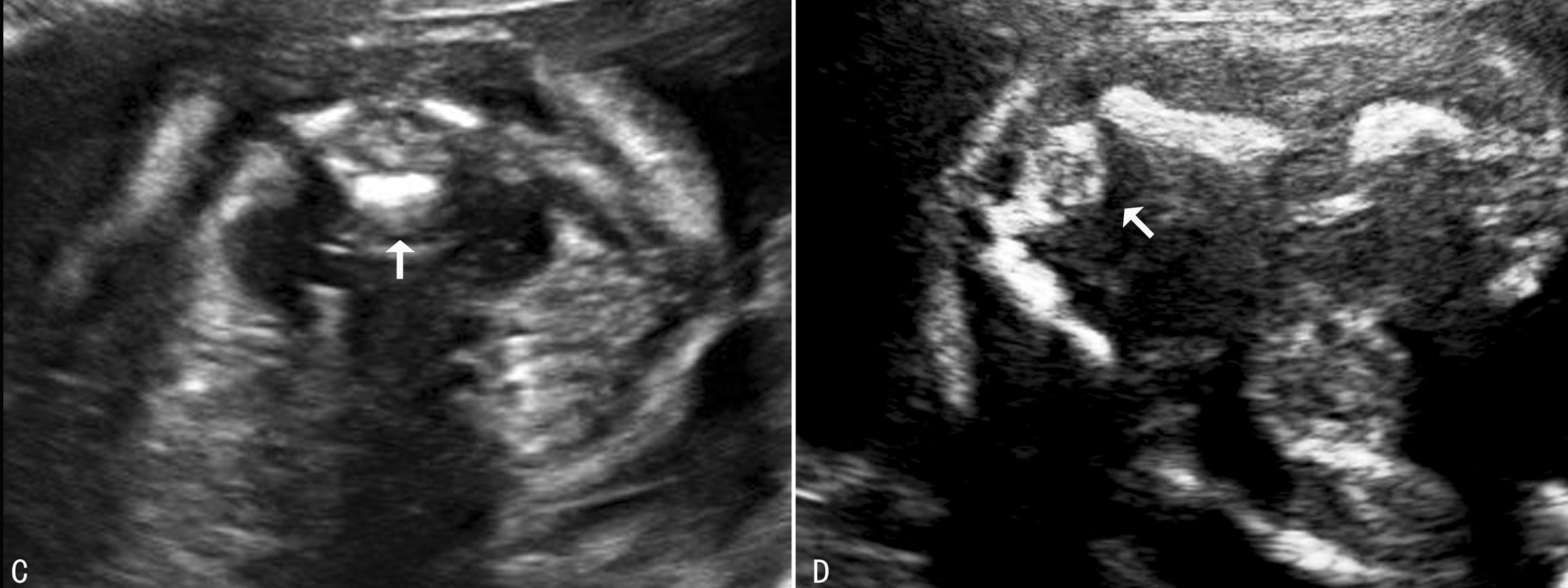 胎儿神经系统发育异常的超声表现,胎儿中枢神经系统超声检查视频