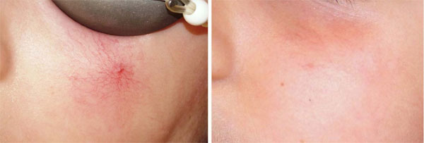 肝病早期不痛不痒身上长两种痣,身体长红痣肝病的早期症状有哪些