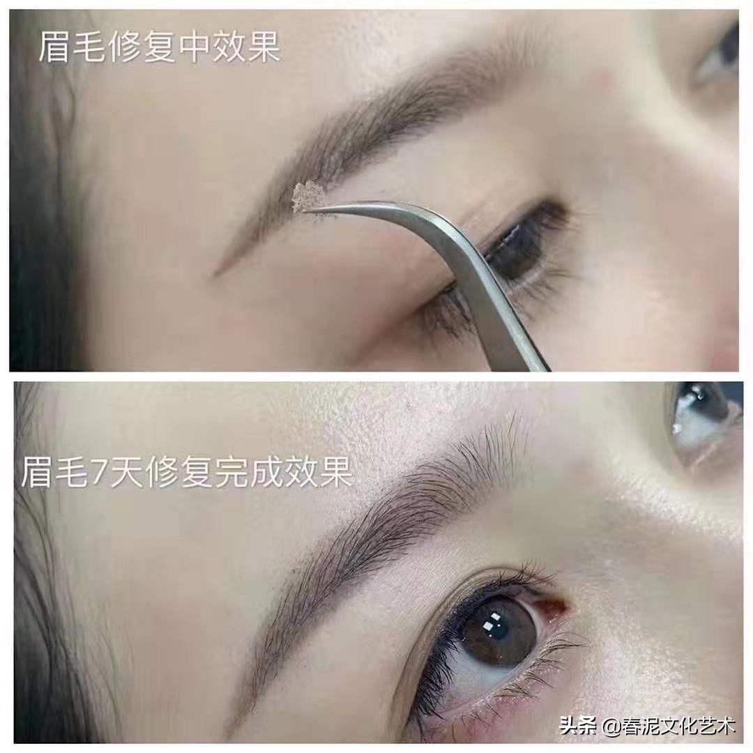 结痂是掉得越晚恢复越好吗,结痂最快的恢复办法