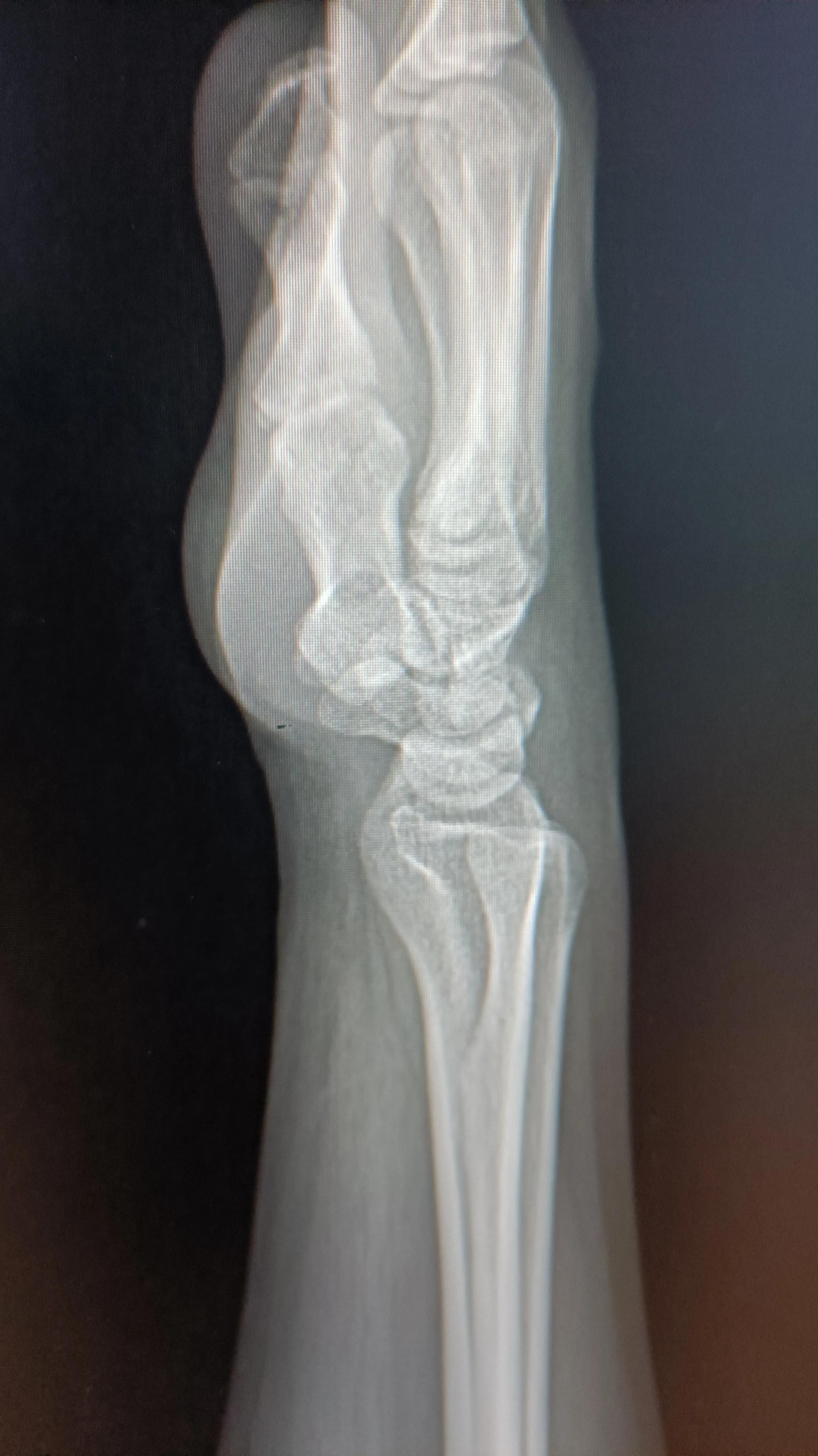 小孩子指甲从根部脱落是怎么回事,孩子手足口病后指甲脱落怎么回事