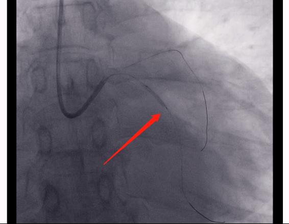 60岁冠心病胸闷气短吃什么药,冠心病患者出现胸闷后怎么处理